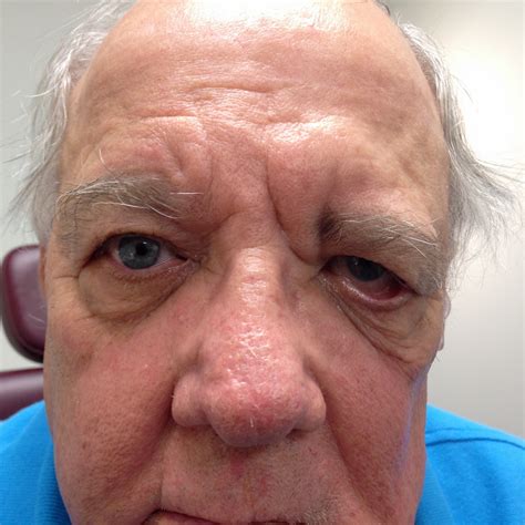 Read about symptoms and treatments. Bell's Palsy: What are the treatment options in Denver if ...