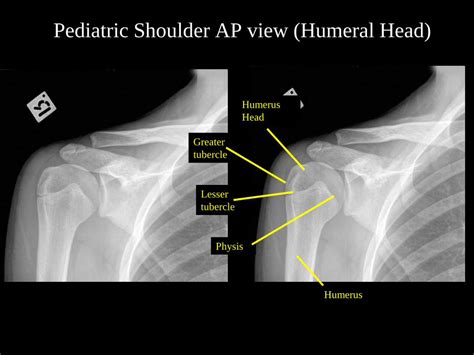 Pdf Pediatric Shoulder Ap View Humeral Head · Pdf Filehumerus