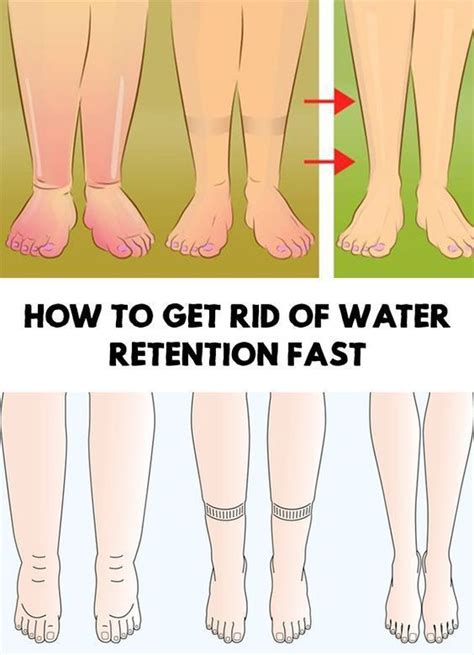 8 Best Home Remedies To Reduce Water Retention Water Retention