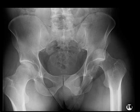 Pre Operative X Ray Of The Pelvis Ap Showing Fracture Dislocation