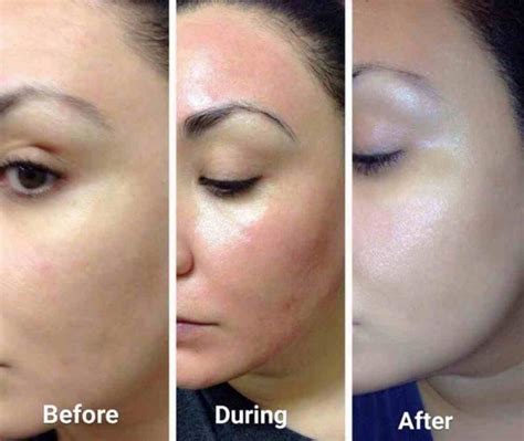 Dermaroller For Anti Aging The Magical Tool To Boost Collagen And