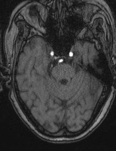 Choroid Plexus Xanthogranuloma Unilateral Radiopaedia 85632 101393