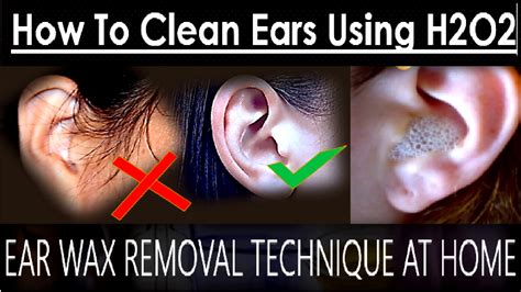 A solution of half warm water and half peroxide works well. How to clean ears with hydrogen peroxide and water ...
