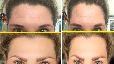 Forehead Wrinkles How To Reduce And Prevent Forehead Wrinkles
