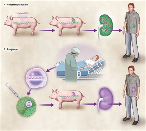 Immune And Genome Engineering As The Future Of Transplantable Tissue Nejm