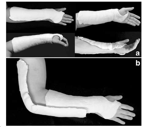 Types Of Immobilization Below Elbow Cast A Above Elbow Cast B