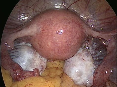 Journal Of Postgraduate Gynecology And Obstetrics Rare Case Of Bilateral