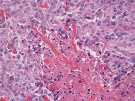 Carcinoma Delle Cellule Basali Fotografia Stock Immagine Di Macchiato
