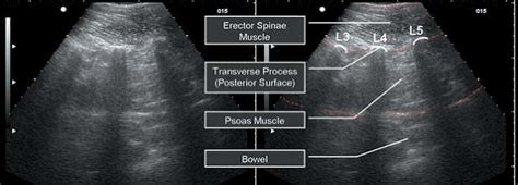 Ultrasound Guided Lumbar Plexus Blocks Teachme Orthopedics