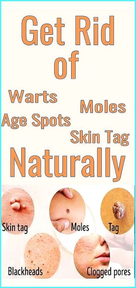how to get rid of warts moles age spots and skin tag using natural remedies get rid of warts