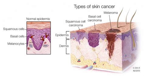 What You Need To Know About Skin Cancer Mayo Clinic News Network