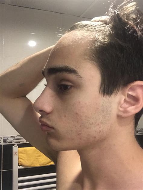 Guys I Have A Pretty Big Foreheadbad Hairline What Should I Do Hair