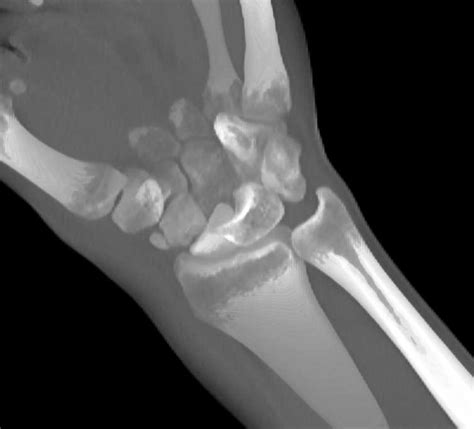Fracture Dislocation Of The Carpal Bones Musculoskeletal Case Studies