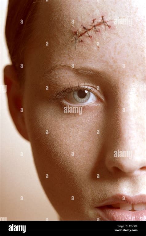 Laceration Forehead Hi Res Stock Photography And Images Alamy