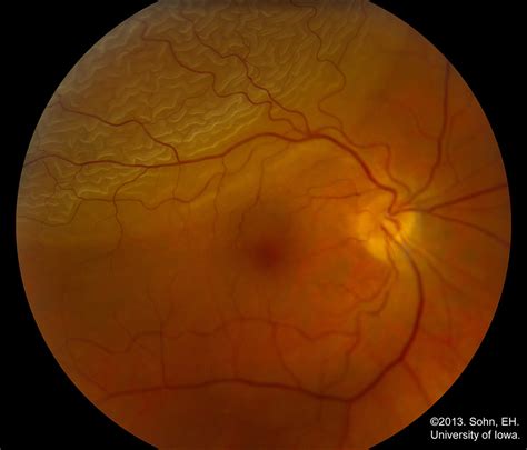 Retinal Detachment From One Medical Student To Another