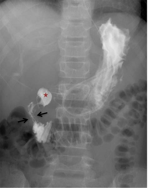 Cureus Duodenal Diverticulosis As An Unusual Cause Of Severe