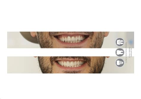 Coroas Ceramicas Clinica Dentaria Oral Reabilitação