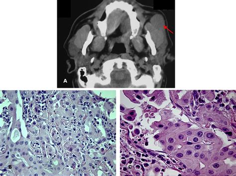 Oncocytic Carcinoma Of The Parotid Gland With Late Cervical Lymph Node