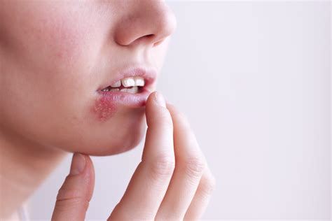 Breaking Down The Differences Between Oral And Genital Herpes Aka Hsv