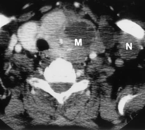 Navigating The Thoracic Inlet Radiographics