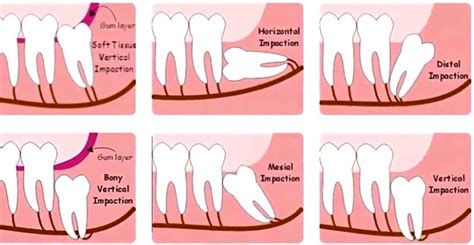 Symptoms And Signs That Your Wisdom Teeth Are Coming In Boston