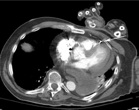 E Ct Angiography Of The Chest With Intravenous Contrast Axial View