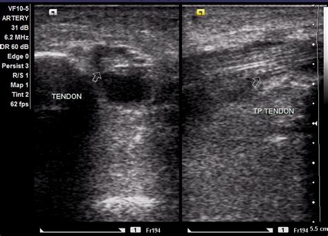Radiodiagnosis Imaging Is Amazing Interesting Cases Tibialis