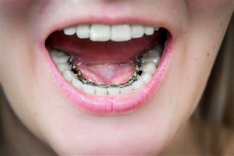 Lingual Braces Vs Invisalign Which One Is Right For You