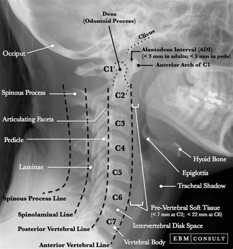 Lateral Cervical Spine X Ray Lines Radiology Student Radiology