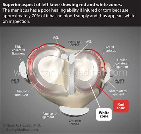 Maybe you would like to learn more about one of these? Does stem cell therapy for knee meniscus tears and post ...