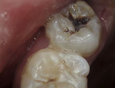 Wisdom Teeth In Or Out Supa Dental Melton Vic 3337