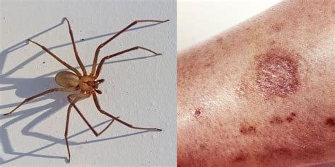 How To Treat A Spider Bite And When To Seek Medical Attention Business Insider India