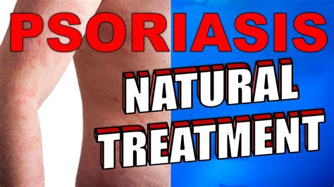 Natural Herbal Remedies For Psoriasis And Psoriatic Arthritis Youtube