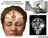 Pictures of What Are The Side Effects Of Brain Surgery
