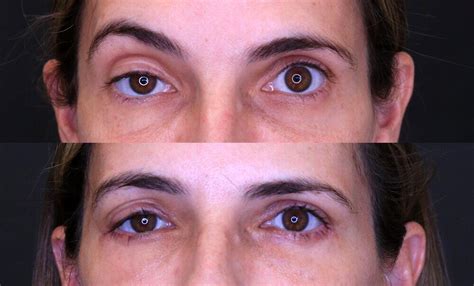 Ptosis Repair Before And After 04 Dr Rodriguez Feliz