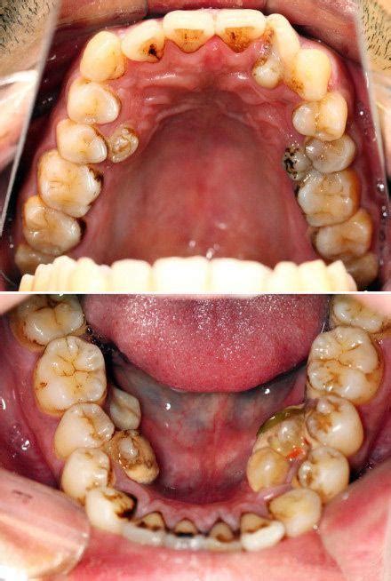 Hyperdontia Supernumerary Teeth Rforbiddenteeth