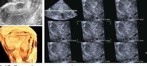 Figure 8 From Ultrasound Assessment Of The Uterine Wall After