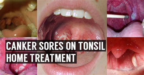 Canker Sore On Tonsil Or Throat Home Remedies