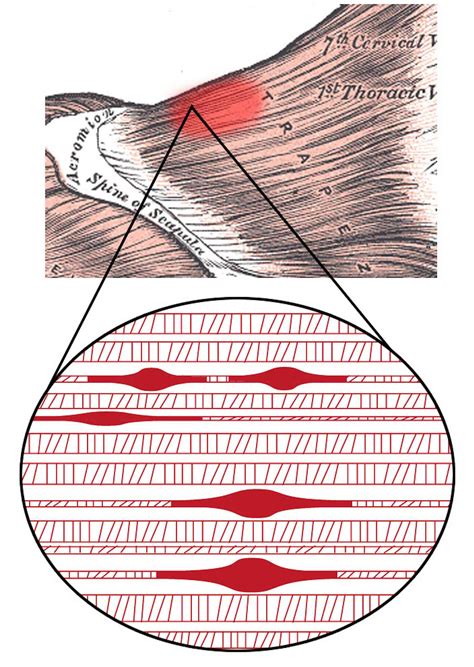 What Are Muscle Knots An Exercise Physiologist Explains What Those