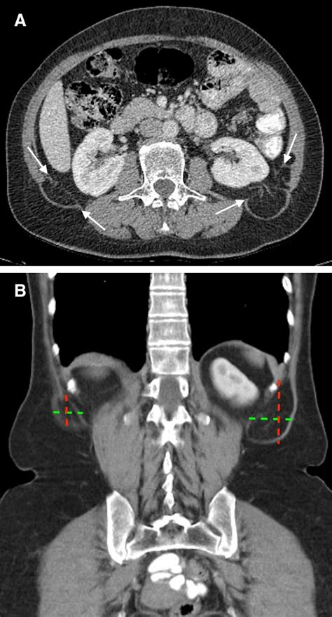 Lateral Incisional Abdominal Wall Hernia 48 Year Old Male Presenting