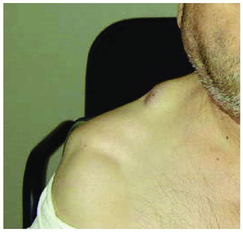 Appearance Of The Patient Note The Swelling Of The Parotid And