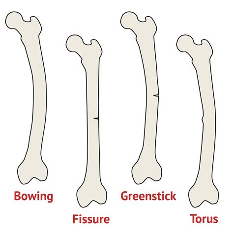 4 Types Of Fractures