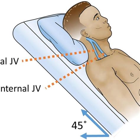 The Typical Position Of The Patient Is 45° When Evaluating Jugular Download Scientific Diagram