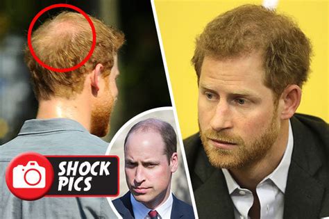 Последние твиты от prince harry hair (@oopsl0u). Prince Harry hair loss: Pics show royal will soon be as ...