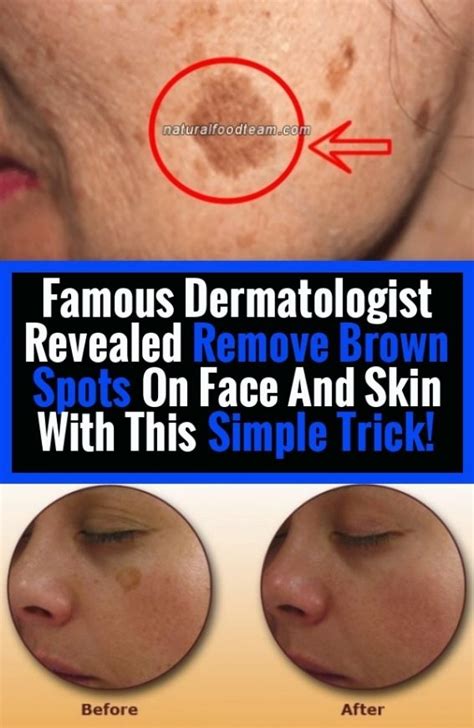 Remove Brown Spots On Face And Skin With This Simple Trick Famous