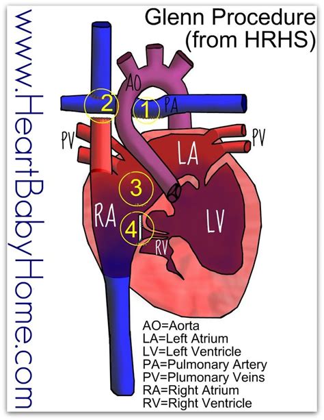 Glenn Procedure Oxygen Poor Blood Coming Back From The Top Half Of The