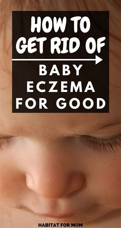 Best Remedies For Baby Eczema Ultimate List In 2020 Baby Eczema