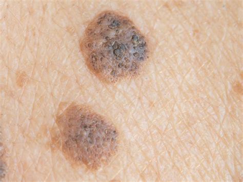 The shot doesn't seem to have that affect. Moles: Types, causes, treatment, and diagnosis