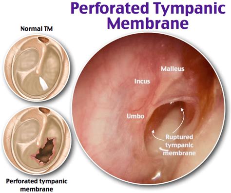 Perforated Tympanic Membrane Perforated Tympanic Grepmed