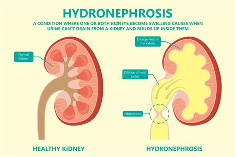 Hydronephrosis In Babies Causes Symptoms And Treatment